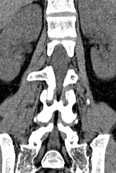 Normal CT lumbar spine (Radiopaedia 53981-60118 F 56).jpg