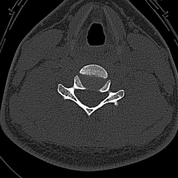 Normal CT of the cervical spine (Radiopaedia 53322-59305 Axial bone window 171).jpg