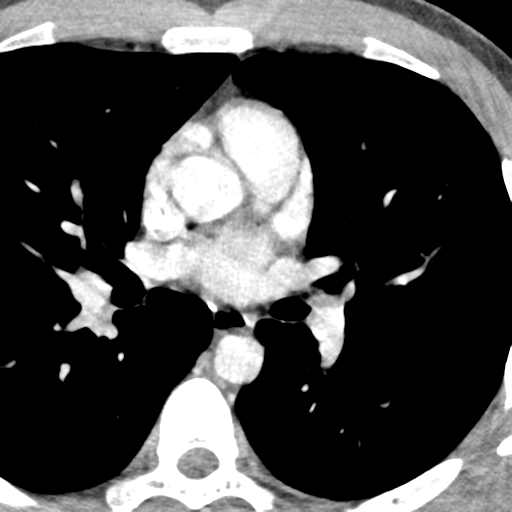File:Normal CT pulmonary veins (pre RF ablation) (Radiopaedia 41748-44702 A 113).png