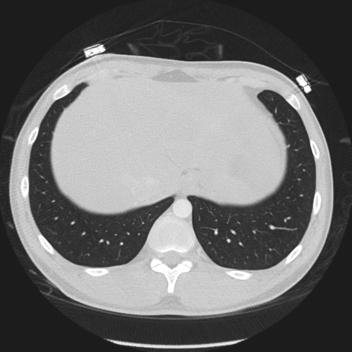 Normal CT pulmonary veins (pre RF ablation) (Radiopaedia 41748-44702 Axial lung window 60).png