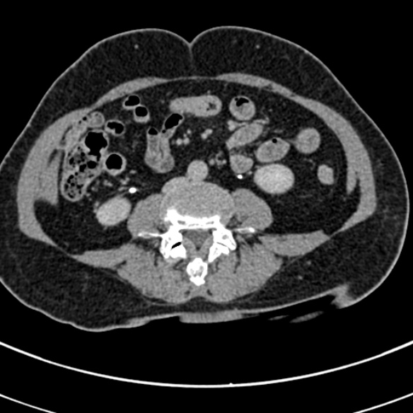 File:Normal CT split bolus study of the renal tract (Radiopaedia 48631-53634 Axial split bolus 153).jpg