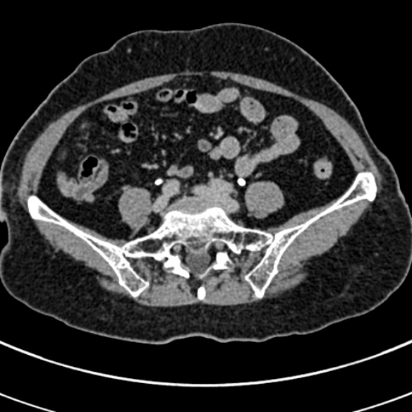 File:Normal CT split bolus study of the renal tract (Radiopaedia 48631-53634 Axial split bolus 198).jpg
