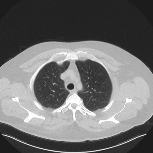 Normal HRCT (Radiopaedia 40797-43458 Axial lung window 14).png