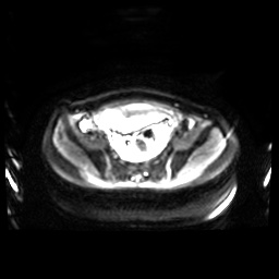 Normal MRI abdomen in pregnancy (Radiopaedia 88001-104541 Axial DWI 10).jpg