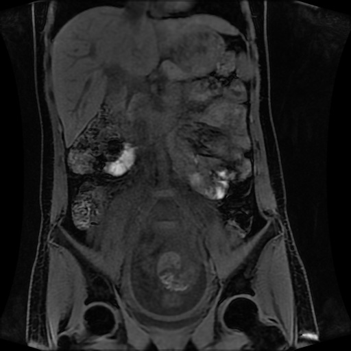 Normal MRI abdomen in pregnancy (Radiopaedia 88001-104541 M 71).jpg