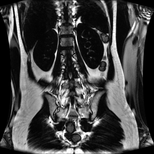 Normal MRI abdomen in pregnancy (Radiopaedia 88001-104541 N 103).jpg