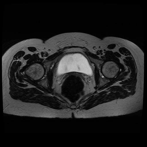 Normal MRI abdomen in pregnancy (Radiopaedia 88005-104548 Axial T2 41).jpg
