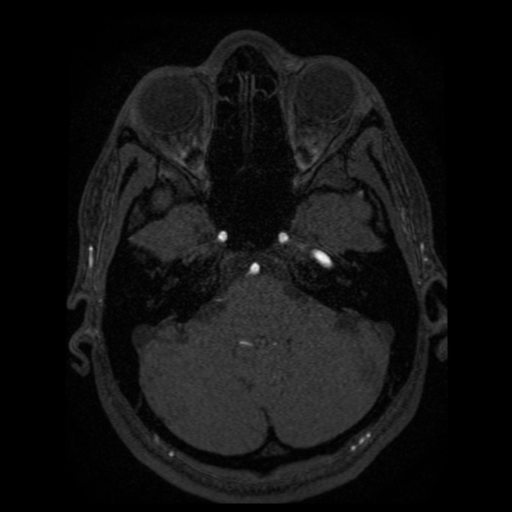 Normal brain MRA (Radiopaedia 41046-43793 Axial MRA 89).png