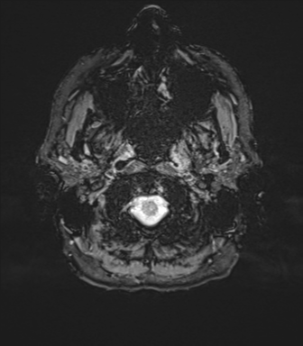 Normal brain MRI (TLE protocol) (Radiopaedia 40748-43405 Axial SWI 3).png