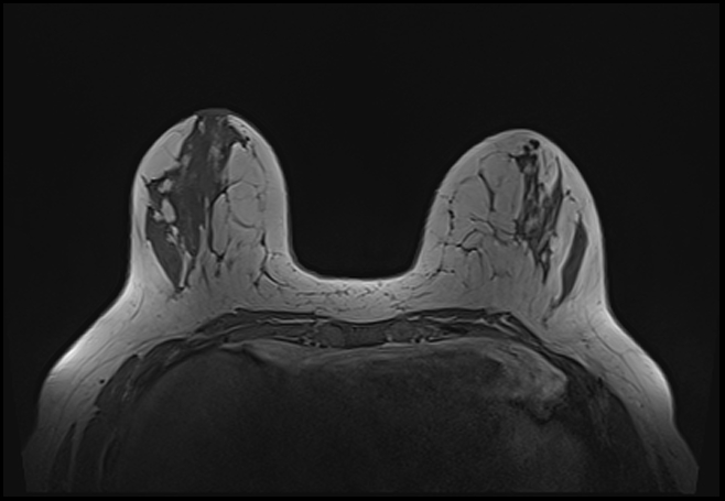 File:Normal breast MRI - dense breasts (Radiopaedia 80454-93850 Axial T1 75).jpg