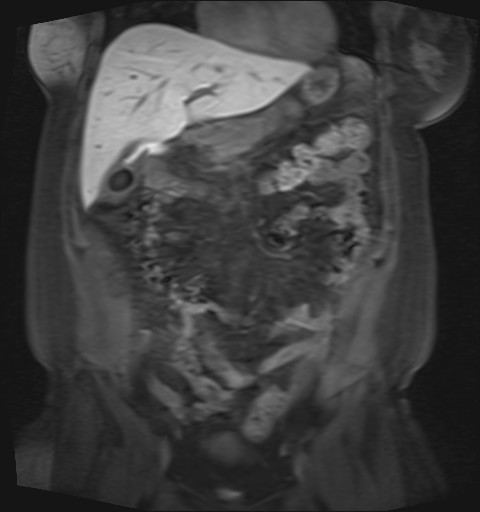 File:Normal hepatobiliary phase liver MRI (Radiopaedia 58968-66230 B 35).jpg