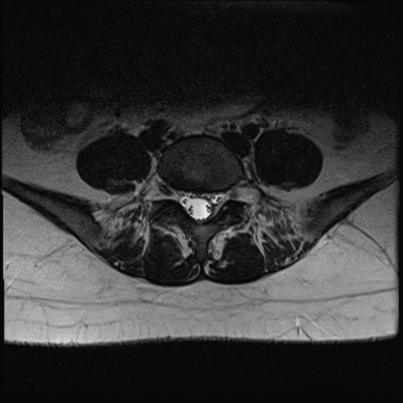File:Normal lumbar spine MRI- 3 T (Radiopaedia 53280-59250 Axial T2 25).jpg