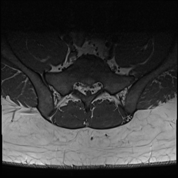 File:Normal lumbar spine MRI (Radiopaedia 47857-52609 Axial T1 31).jpg