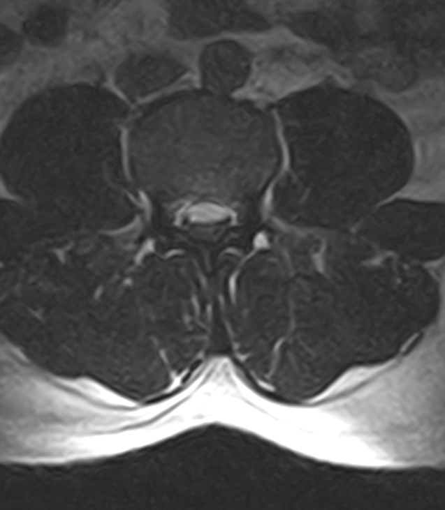 Normal lumbar spine MRI - low-field MRI scanner (Radiopaedia 40976-43699 Axial T2 56).jpg