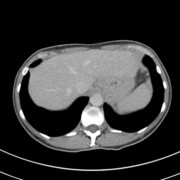 File:Normal multiphase CT liver (Radiopaedia 38026-39996 Axial C+ delayed 11).jpg