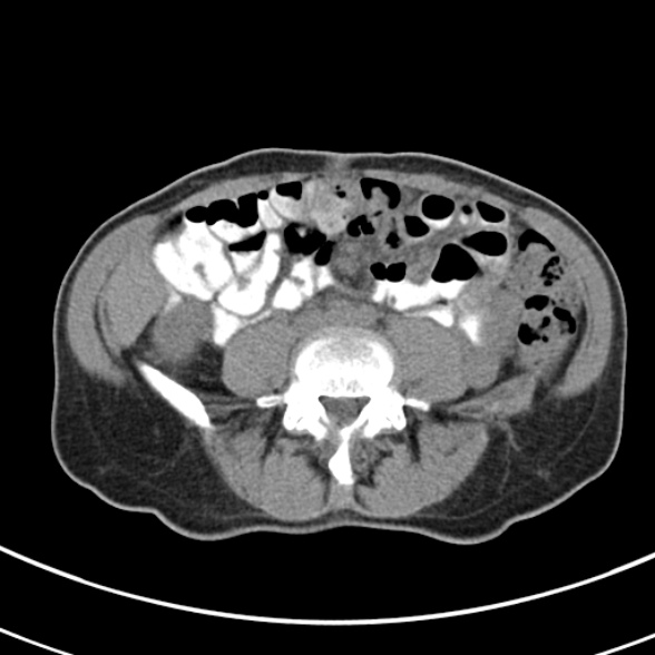 File:Normal multiphase CT liver (Radiopaedia 38026-39996 Axial non-contrast 52).jpg
