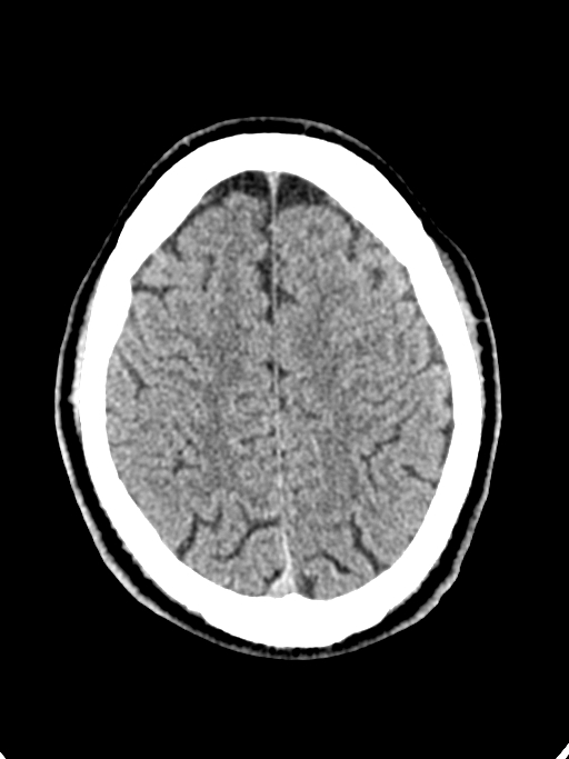 Normal trauma protocol brain and C-spine CT (Radiopaedia 83302-97709 Axial non-contrast 22).jpg