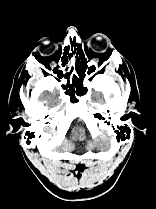 Normal trauma protocol brain and C-spine CT (Radiopaedia 83302-97709 Axial non-contrast 60).jpg