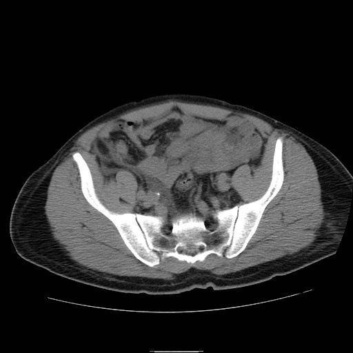 File:Obstructed kidney with perinephric urinoma (Radiopaedia 26889-27066 Axial non-contrast 52).jpg