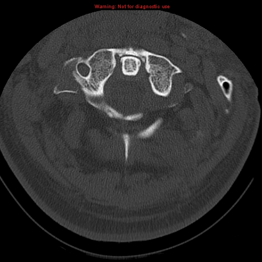 File:Occipital condyle fracture (Radiopaedia 18366-18208 Axial bone window 17).jpg