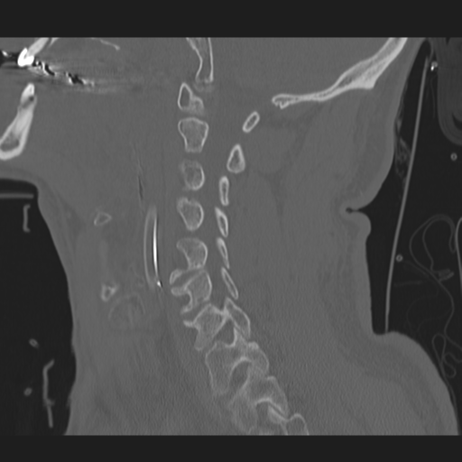 File:Occipital condyle fracture (Radiopaedia 33467-34517 Sagittal bone window 28).png