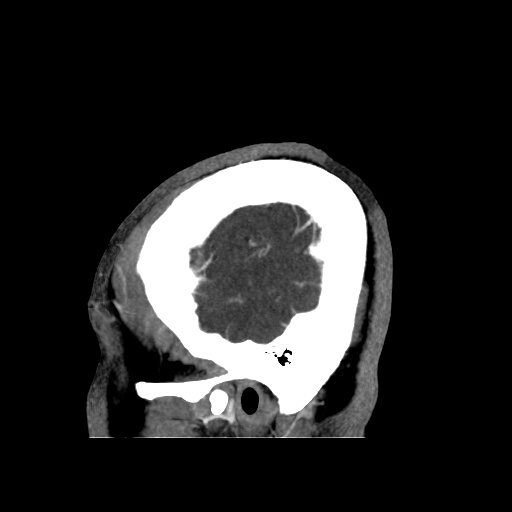 Occipital extradural hematoma simulating venous sinus thrombosis (Radiopaedia 46514-50964 D 71).jpg