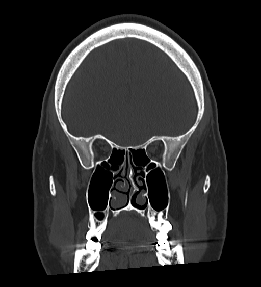Occipital spur and Currarino type A atlas anomaly (Radiopaedia 87027-103285 Coronal bone window 55).jpg