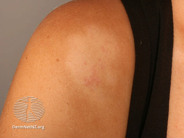 File:Pityrasis alba (DermNet NZ dermatitis-s-pityriasis-alba-2).jpg