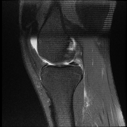 File:ACL acute full thickness tear - deep lateral femoral sulcus sign (Radiopaedia 38594-40740 Sagittal PD fat sat 8).jpg