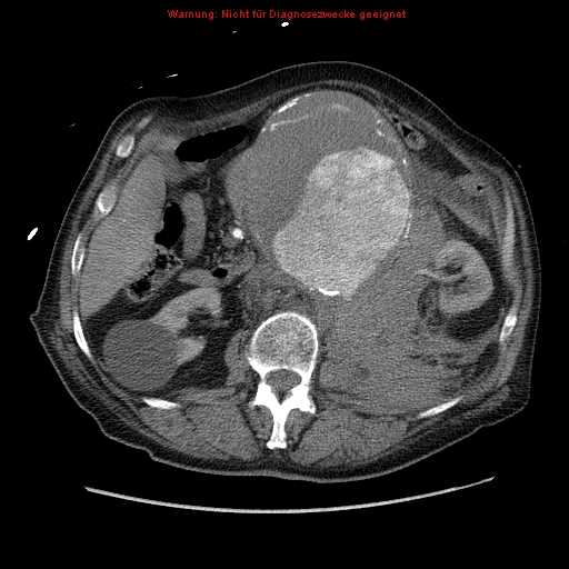 Abdominal aortic aneurysm- extremely large, ruptured (Radiopaedia 19882-19921 Axial C+ arterial phase 28).jpg