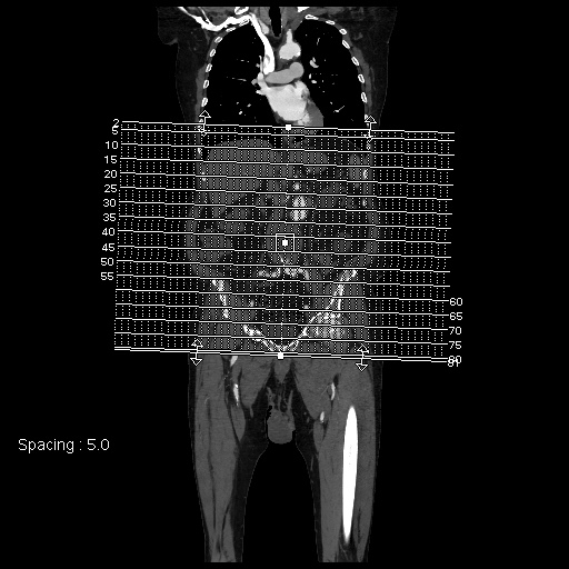 File:Abdominal aortic aneurysm (Radiopaedia 57318-64259 Axial C+ arterial phase 1).jpg