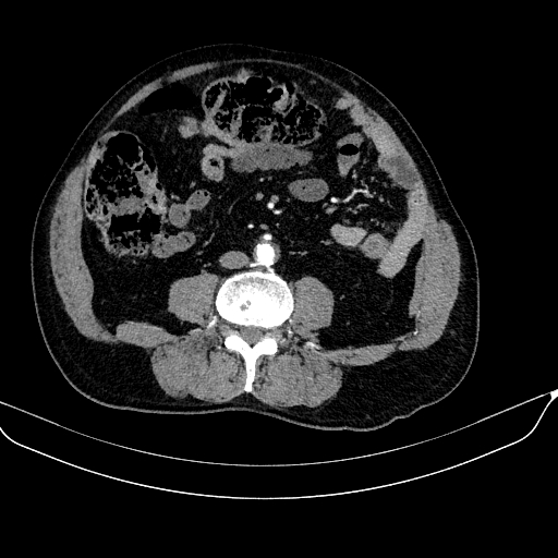 Abdominal aortic aneurysm (Radiopaedia 67117-76452 Axial C+ arterial phase 79).jpg