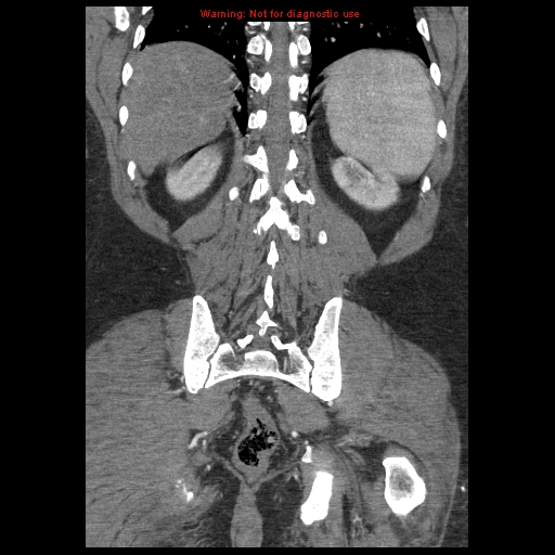 File:Abdominal aortic aneurysm (Radiopaedia 8190-9038 Coronal C+ arterial phase 102).jpg