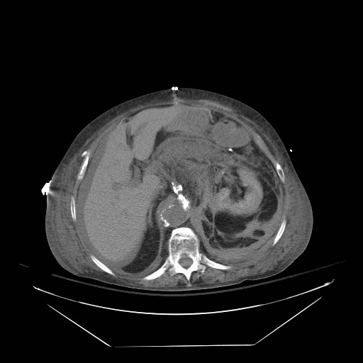 Abdominal aortic aneurysm - impending rupture (Radiopaedia 19233-19247 Axial non-contrast 55).jpg