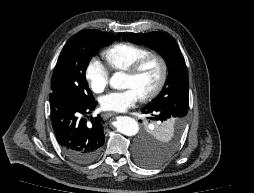 Abdominal aortic aneurysm rupture (Radiopaedia 54179-60362 Axial C+ arterial phase 13).jpg