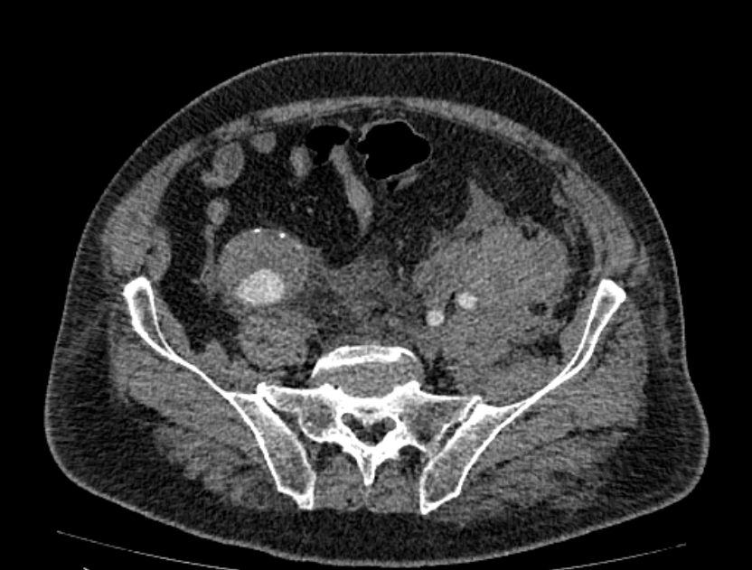 Abdominal aortic aneurysm rupture (Radiopaedia 54179-60362 Axial C+ arterial phase 44).jpg