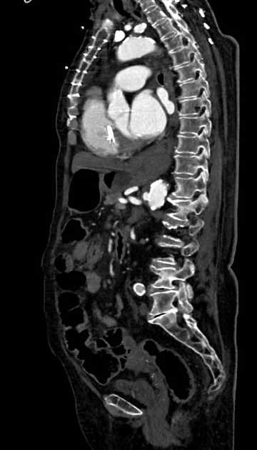 Abdominal aortic aneurysm with thrombus fissuration (Radiopaedia 73192-83919 Sagittal C+ arterial phase 60).jpg