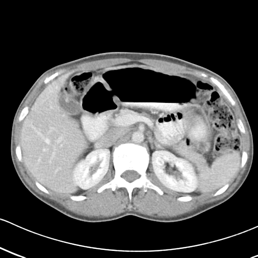 File:Abdominal desmoid tumor (Radiopaedia 41007-43740 Axial C+ portal venous phase 18).png