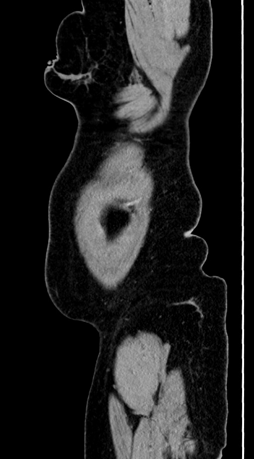 Abdominal hydatid disease (Radiopaedia 68223-77737 Sagittal C+ portal venous phase 1).jpg