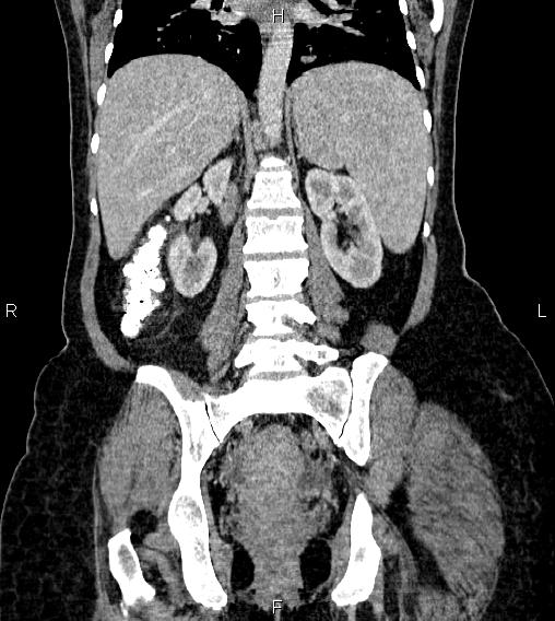 Abdominal lymphoma with sandwich sign (Radiopaedia 84378-99704 Coronal C+ portal venous phase 44).jpg
