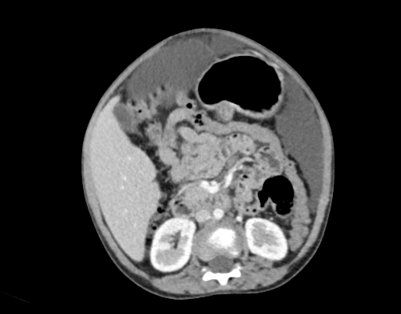 Abdominal premesenteric cystic lymphangioma (Radiopaedia 82995-97350 Axial C+ portal venous phase 27).jpg