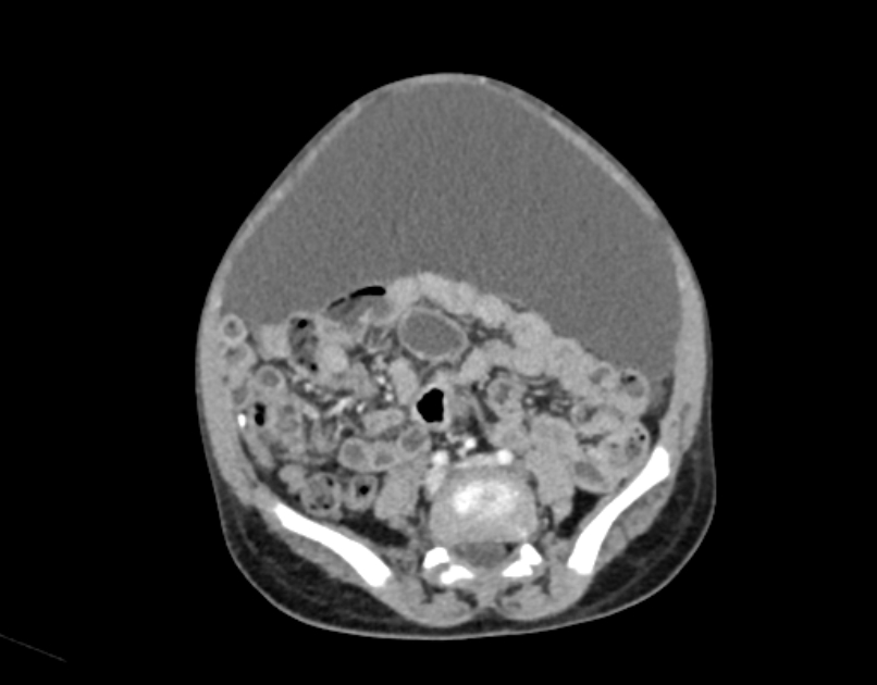 Abdominal premesenteric cystic lymphangioma (Radiopaedia 82995-97350 Axial C+ portal venous phase 43).jpg