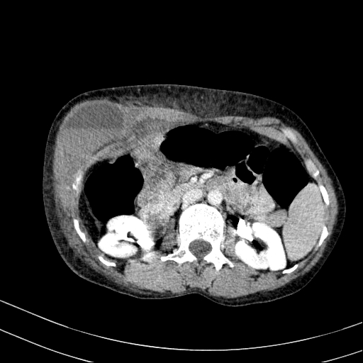 Abdominal wall hematoma with active bleeding (Radiopaedia 83915-99122 Axial contrast-enhanced CT 2).jpg