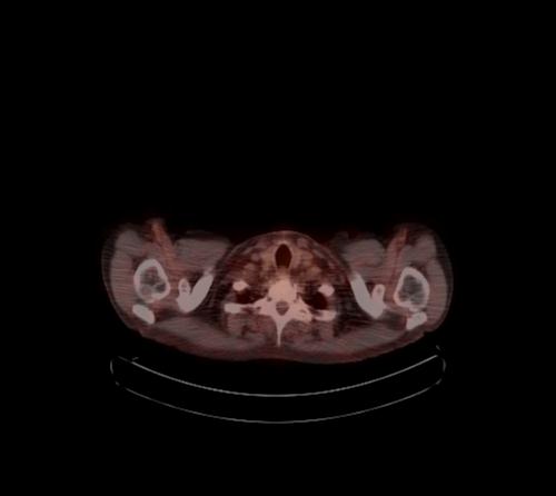 Abdominal wall metastasis from colorectal carcinoma (Radiopaedia 31016-31719 C 129).jpg