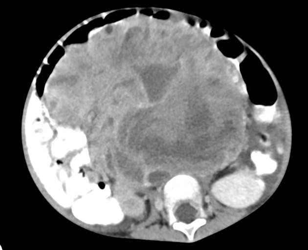 Abdominopelvic rhabdomyosarcoma (Radiopaedia 78356-90984 Axial C+ portal venous phase 97).jpg