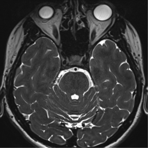 File:Abducens nerve palsy (Radiopaedia 51069-56648 Axial T2 fat sat 44).png