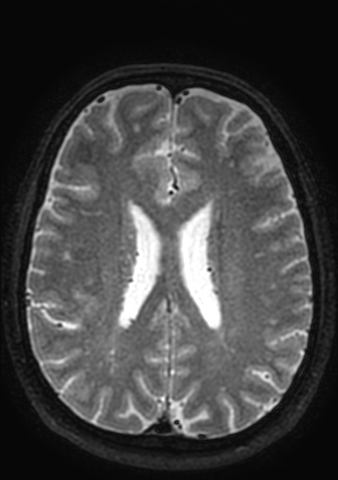 Accessory middle cerebral artery (Radiopaedia 73114-83828 Axial T2 24).jpg