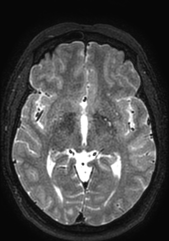 Accessory middle cerebral artery (Radiopaedia 73114-83828 Axial T2 88).jpg