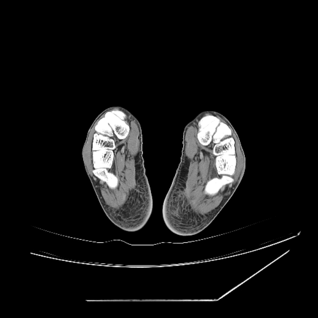 Accessory soleus muscle (Radiopaedia 61069-68943 Axial non-contrast 74).jpg