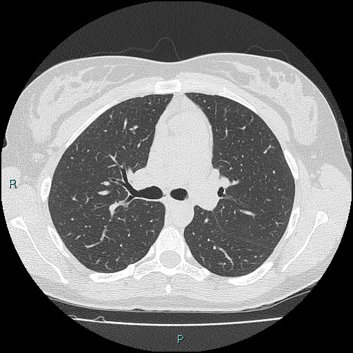 File:Accidental foreign body aspiration (seamstress needle) (Radiopaedia 77740-89983 Axial lung window 26).jpg
